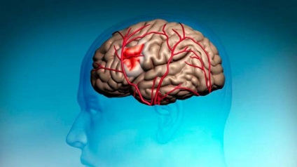 Okok és stroke megelőzésére (stroke) A stroke okaira és megelőzésére