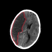 Stroke tüneteinek és az elsősegély (stroke) Stroke tüneteinek és elsősegély