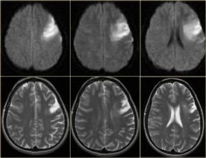 Ischaemia cerebrovaszkuláris tünetek, típusok, kezelés, következményei (hajók) Az ischaemia cerebrovascularis tünetek, fajta kezelés következményei