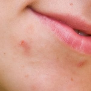 Hogyan kell kezelni a forraljuk legkorábban fajta betegség (hogyan kell kezelni egy forraljuk a szamár) Hogyan kell kezelni a forraljuk legkorábban fajta betegség