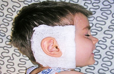 Kámforolaj alkalmazásra a fül középfülgyulladás, hogy a gyermekek is csöpög, és hogyan kell kezelni