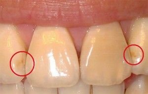 A fogszuvasodás az elülső fogak kezelik