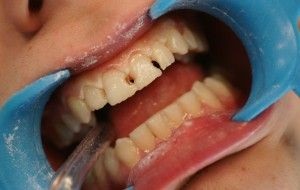 A fogszuvasodás az elülső fogak kezelik