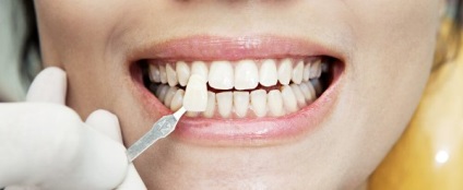 A fogszuvasodás az elülső fogak, különösen kezelések