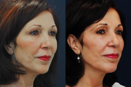arc korrekció növeli az arccsontja