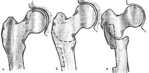 Korrekciós osteotomiával és forgó mag műveletek szövődmények