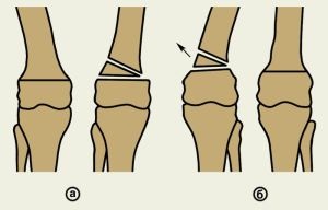 Korrekciós osteotomiával és forgó mag műveletek szövődmények