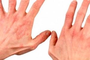 Kiütés a kéz és az ujjak az okok, tünetek és a kezelés felnőtteknek