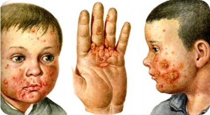 A kezelés impetigo - orvosi portál EUROLAB (öntsünk egy liter forrásban lévő vízzel) A kezelés impetigo - orvosi portál EUROLAB