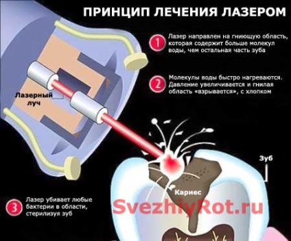 caries kezelés fúrás nélkül fogak és fúró (fotó és videó) (kezelés) caries kezelés fúrás nélkül fogak és fúró (fotó és videó)