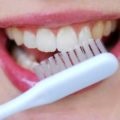 caries kezelés fúrás nélkül fogak és fúró (fotó és videó) (fúrás) caries kezelés fúrás nélkül fogak és fúró (fotó és videó)