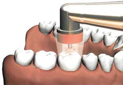 caries kezelés fúrás nélkül fogak és fúró (fotó és videó) (kezelés) caries kezelés fúrás nélkül fogak és fúró (fotó és videó)