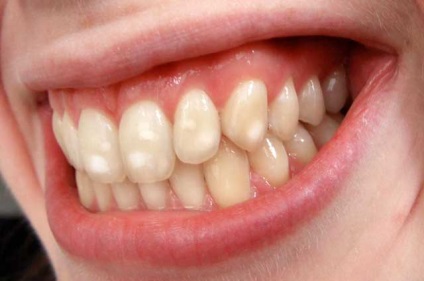 caries kezelés fúrás nélkül fogak és fúró (fotó és videó) (fog) caries kezelés fúrás nélkül fogak és fúró (fotó és videó)