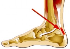 A kezelés a ragadós tendinitis (gyulladás az ín) (íngyulladás) A kezelés a ragadós tendinitis (íngyulladás)