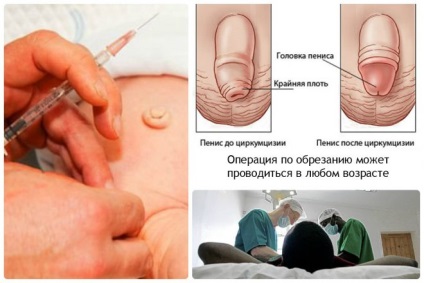 gyulladás a fityma férfiak kezelés cukorbetegség)