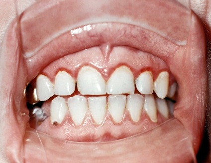 Kezelése ínygyulladás elhelyezhet fogtechnikai a koronát, fogászati ​​kezelés