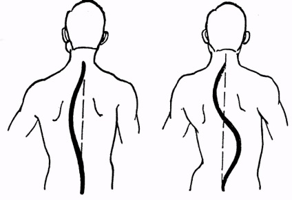 A bal oldali scoliosis a mellkasi és ágyéki szinten a kezelés