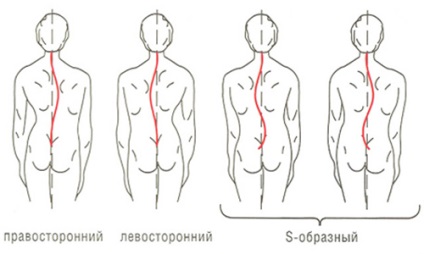 Bal oldali scoliosis a gerinc