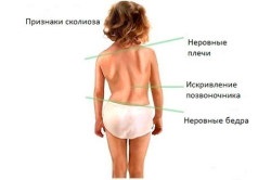 Bal oldali scoliosis a gerinc (gerinc ellátás) Bal oldali scoliosis a gerinc