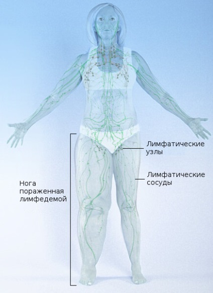 Lymphedema - okait, hatásait és kezelések lymphostasis