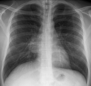 Lipoma a tüdőben (mediastinum, szegycsont) - hogyan megszabadulni, és távolítsa el az okok és kezelés gyorsan (megszabadulni) Lipoma a tüdőben (mediastinum, szegycsont) -, hogyan lehet megszabadulni a gyorsan eltávolítja az okok és kezelés