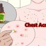 Lipoma a tüdőben (mediastinum, szegycsont) - hogyan megszabadulni, és távolítsa el azonnal az okok és kezelés (parasternalis) Lipoma a tüdőben (mediastinum, szegycsont) -, hogyan lehet megszabadulni a gyorsan eltávolítja az okok és kezelés