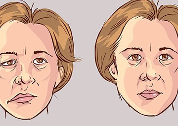 Myasthenia gravis - ocularis formában a betegség