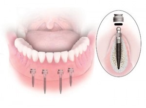 Mini fogászati implantátumok, mini-implantátumok fogak - mi ez, a típusok, árak, fotók előtt és után értékelés (vélemény) Mini fogászati implantátumok, mini-implantátumok fogak - mi ez, a típusok, árak, fotók előtt és után vélemények