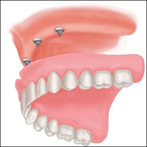 Mini fogászati implantátumok, mini-implantátumok fogak - mi ez, a típusok, árak, fotók előtt és után értékelés (vélemény) Mini fogászati implantátumok, mini-implantátumok fogak - mi ez, a típusok, árak, fotók előtt és után vélemények