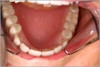 Mini fogászati implantátumok, mini-implantátumok fogak - mi ez, a típusok, árak, fotók előtt és után értékelés (állkapocscsont) Mini fogászati implantátumok, mini-implantátumok fogak - mi ez, a típusok, árak, fotók előtt és után vélemények