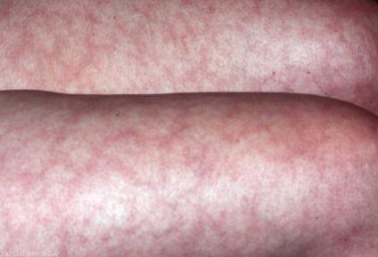 Márvány bőr felnőtteknél okoz a lábak, karok