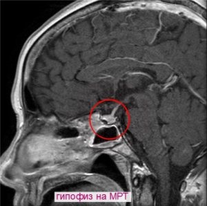 hypophysis MRI kontraszt, amely megmutatja, képzés