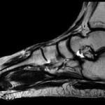 MRI a bokaízület véleménye a lábak tomográfia