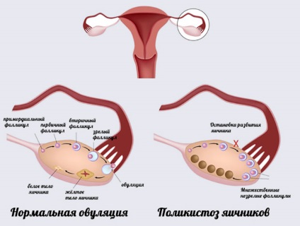 Multifollikulyarnaya petefészek szerkezete okok és a kezelés