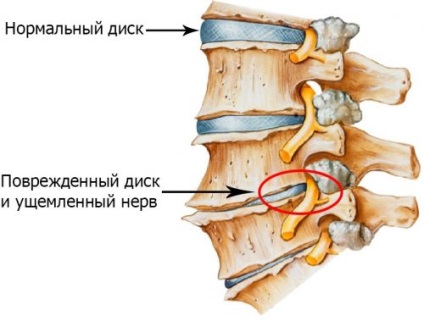 Népi jogorvoslati eltávolítására sókat osteochondrosis