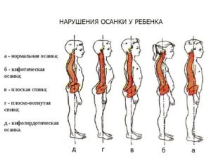 Helytelen testtartás a gyermek ispravleniemama megelőzés - Dr