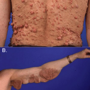 Recklinghausen neurofibromatózis tünetek és a kezelés Recklinghausen betegségek 1. és 2. típusú (neurofibromatózis) Recklinghausen neurofibromatózis tünetek és a kezelés Recklinghausen betegségek 1. és 2. típusú