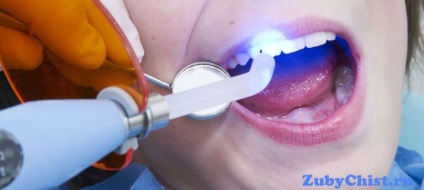 Az új technológia egy hatékony fogászati kezelés fogászati lézer (fogászati) Az új technológia egy hatékony fogászati kezelés fogászati lézer
