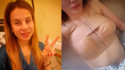 Olga Zhemchugova (Olga szélenergia) előtt és után műanyag - 300