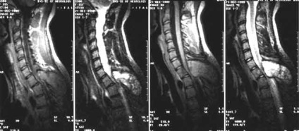 Daganatok a gerincvelő tüneteket, osztályozására, kezelésére és diagnosztizálására rák (extramedulláris tumorok a gerincvelő) Daganatok a gerincvelő tünetek, az osztályozás, a kezelés, a rák diagnózisa
