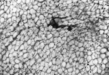 Mediastinalis tumorok kötőszövet (tumor) Mediastinalis tumor kötőszövet