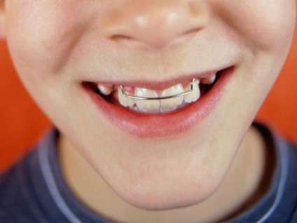 Fogszabályozó lemezek a fogak fotó és leírás eszközök a gyermekek számára