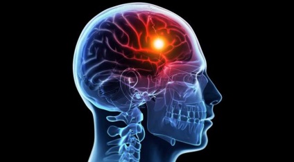 A fő oka a stroke kockázatát csökkentésére (stroke) A fő oka a stroke-kockázat csökkentése