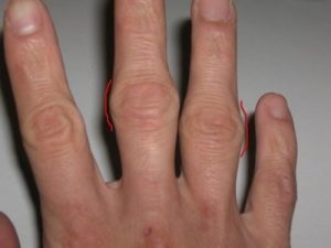 Osteochondrosis az ujjak tünetek, kezelés