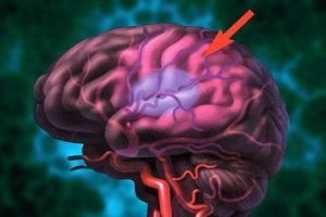Akut és krónikus epidurális hematóma az agy és a kezelés hatását (akut epidurális hematóma) Akut és krónikus epidurális hematóma az agy és a kezelés hatásait