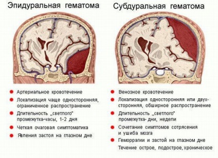 Akut és krónikus epidurális hematóma az agy és a kezelés hatásait