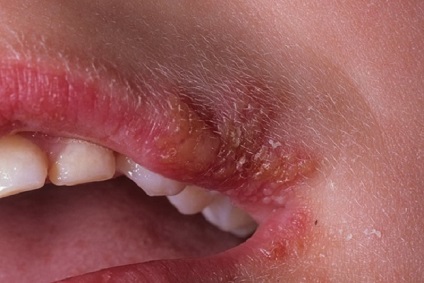 Abból, amit úgy tűnik, herpes labialis (mi) Abból, amit úgy tűnik, ajakherpesz