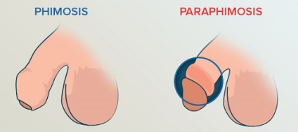 Parafimózis fiúk és a férfiak (hogyan kell kezelni paraphimosis) Parafimózis fiúk és a férfiak