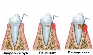 A periodontitis antibiotikumos kezelés, a gyógymód periodontitis