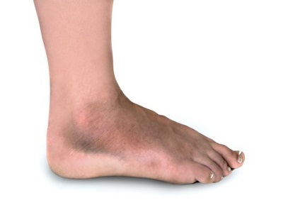 Törés a láb okok, típusok, tünetek, kezelés